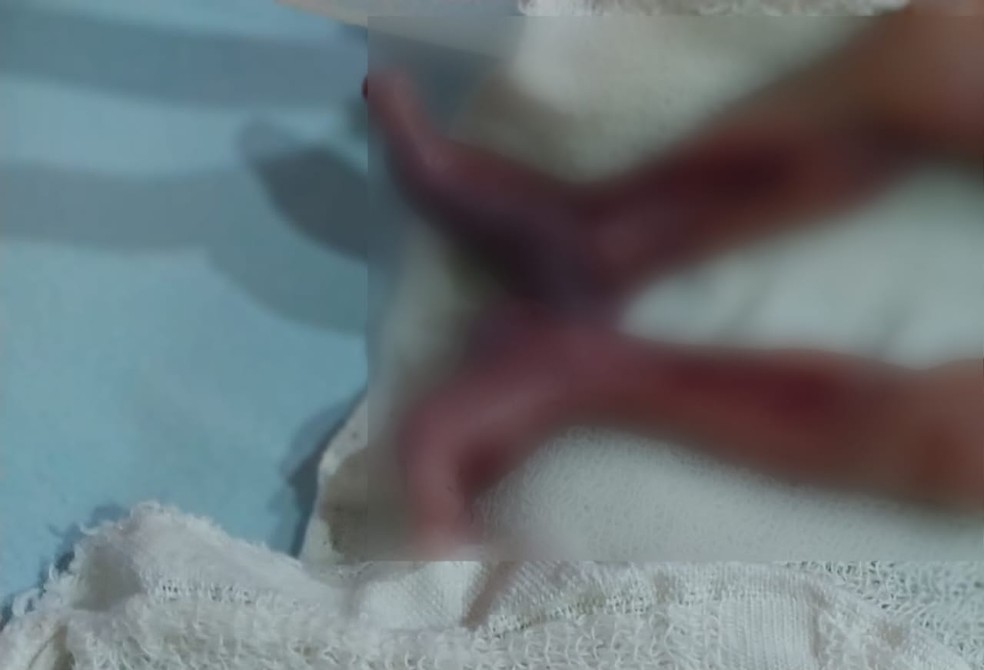 Elizângela mostra pernas de bebê, que afirma que foram machucadas por médico — Foto: Arquivo pessoal