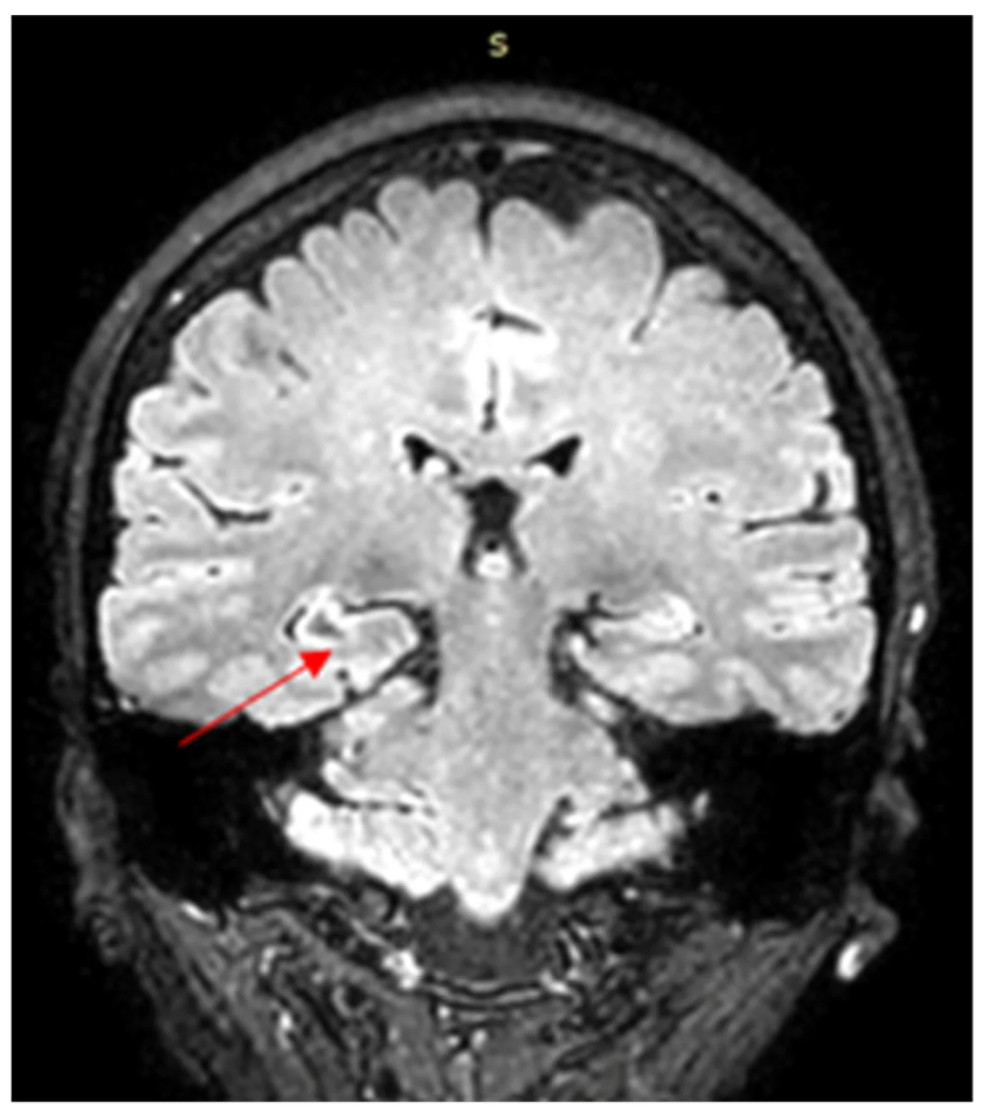2020 (ressonância de controle). Mostra a mesma região de outro ângulo de imagem, em que o hipocampo direito aparece com um sinal irregular. — Foto: Universidade de Medicina e Farmácia Grigore T. Popa Iaşi, 700115 Iaşi, Romênia