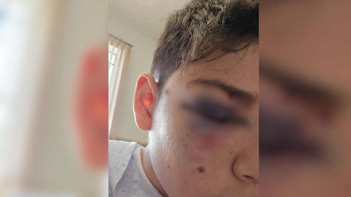 Estudante leva três pontos no rosto após ser agredido por um colega de sala  dentro de escola no interior de SP | São José do Rio Preto e Araçatuba | G1