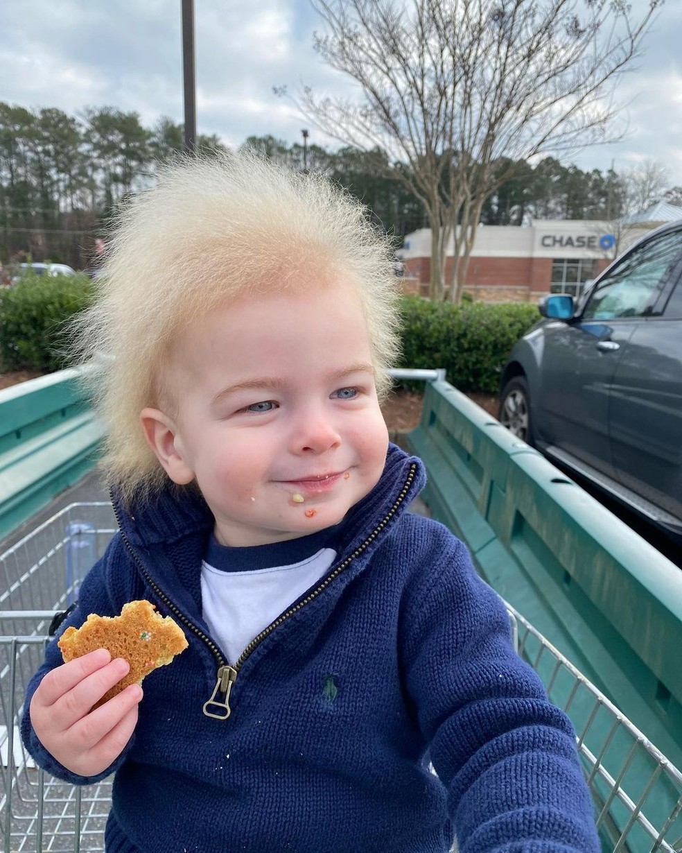 Menino com s ndrome do cabelo impente vel faz sucesso nas redes