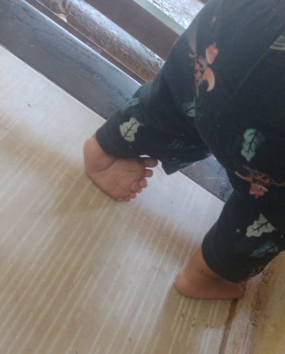 Bebê sofre uma deformidade congênita que deixa o pé dela torto — Foto: Reprodução
