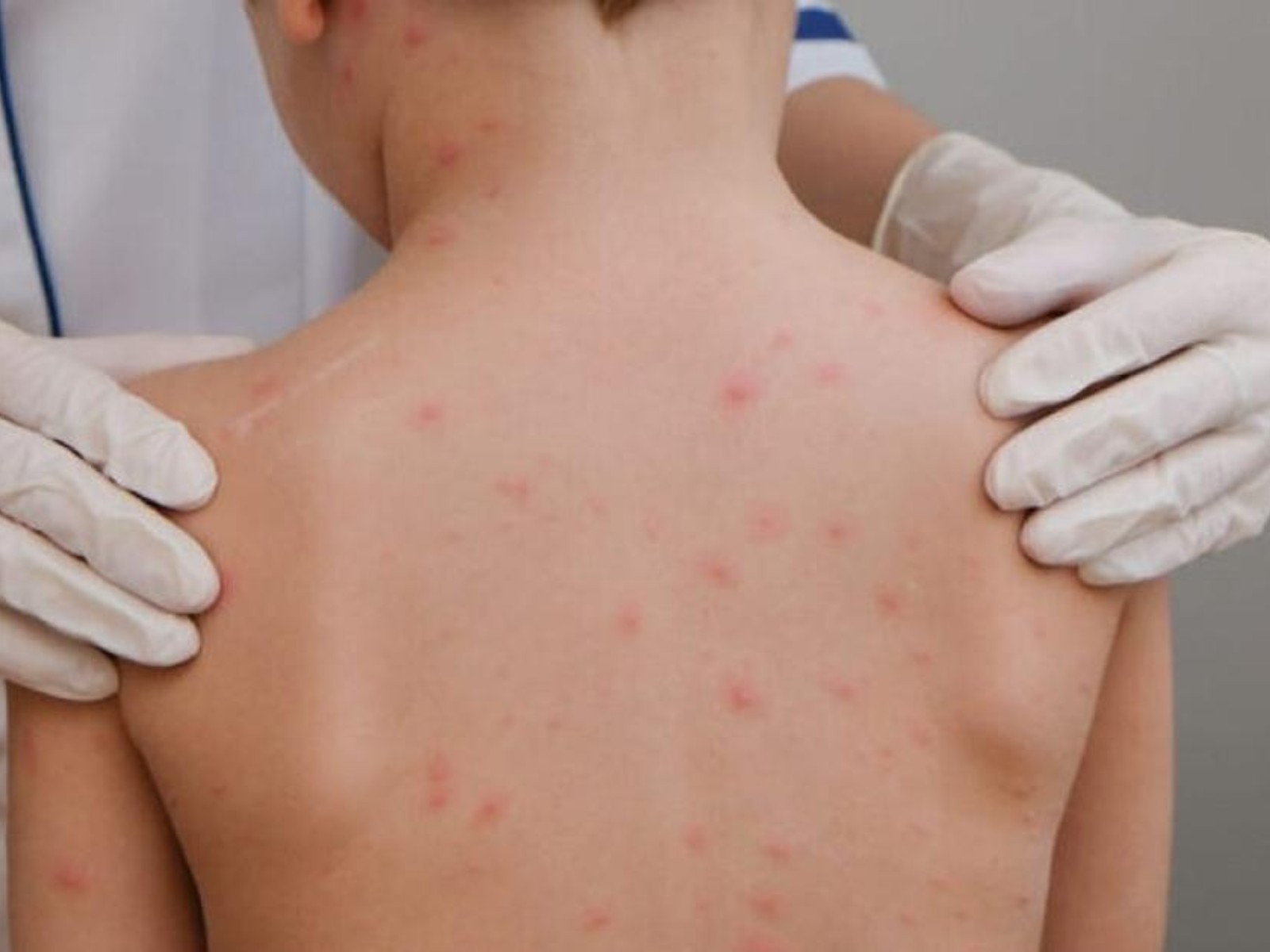 Casos confirmados de meningite caem 35% no Acre em 2026