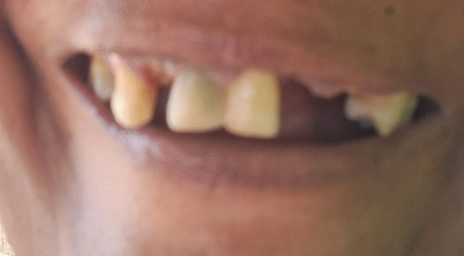Franquia e dentista são alvos de ação milionária por esquema que causou danos a pacientes em RO: 'Entrei com dente e saí sem'