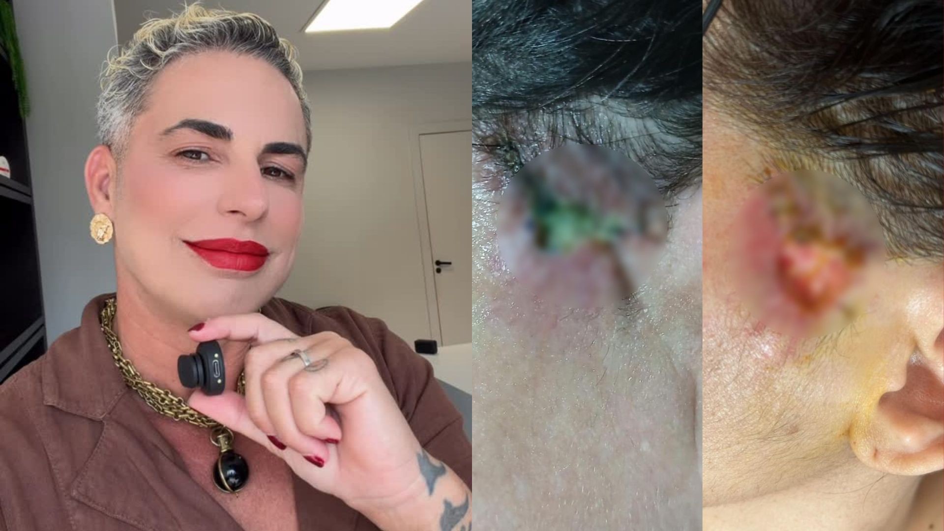 Dentista influencer é indiciada pela PC por lesão corporal após pacientes ficarem deformadas em procedimento irregular no ES