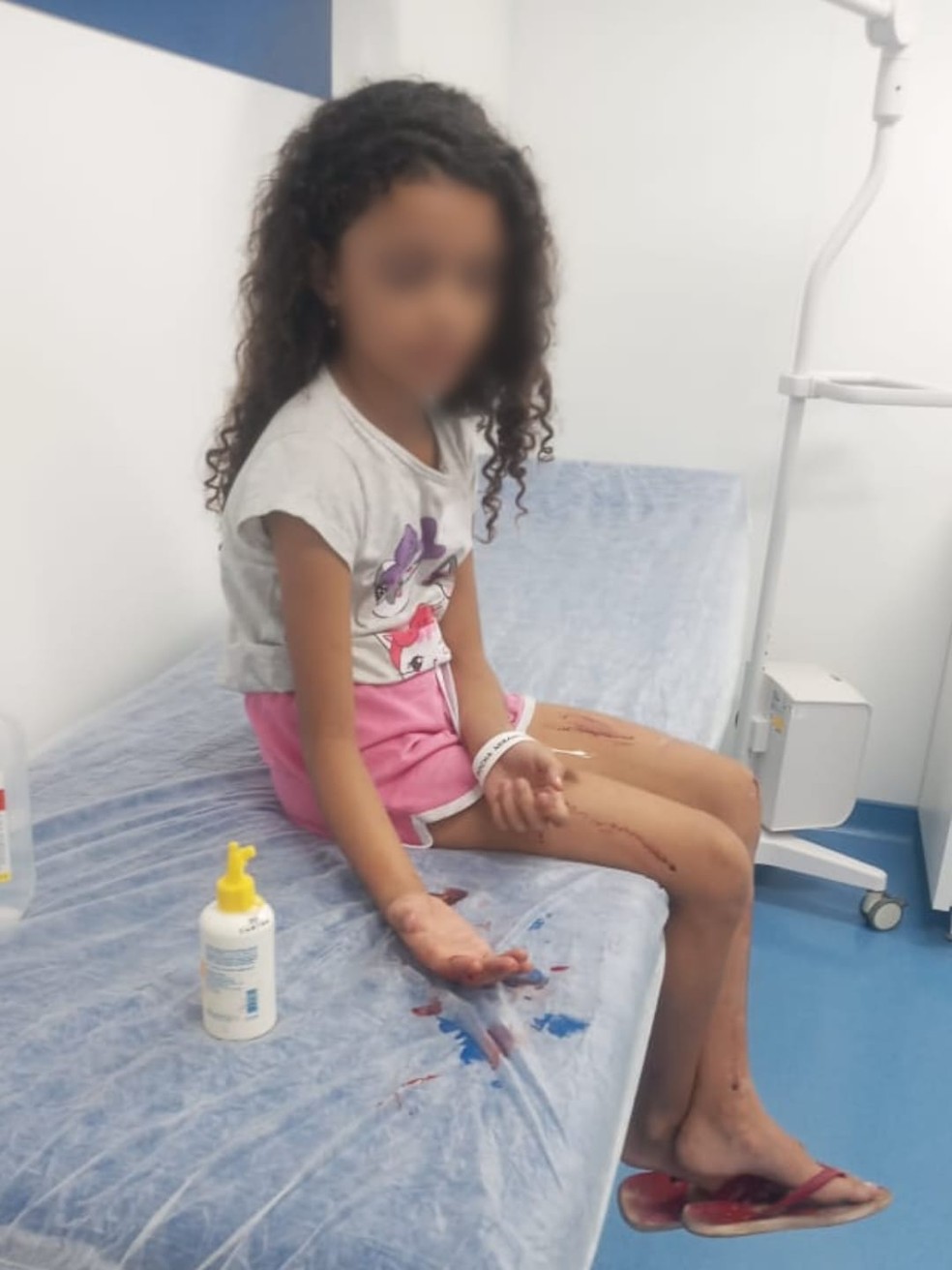A menina de 7 anos teve escoriações pelo corpo e luxação na mão direita, após acidente no Parque Madureira — Foto: Arquivo pessoal