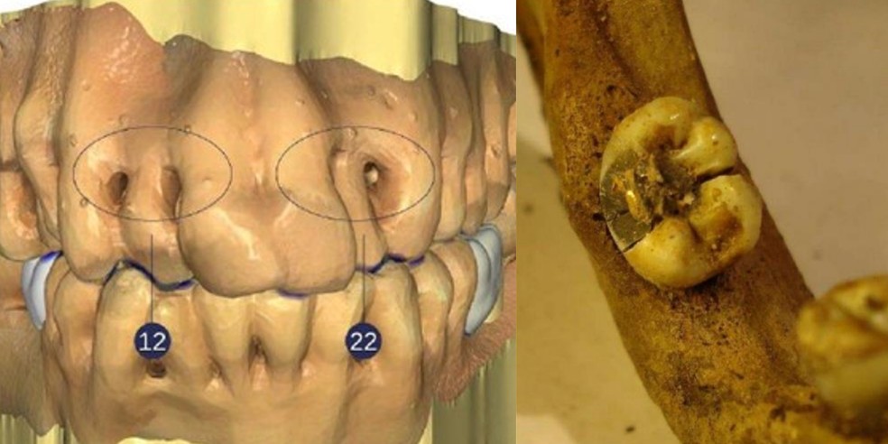 Dentes de Dom Pedro I; à direita, dente tratado e com ouro, possivelmente, segundo historiadora — Foto: Reprodução - Valter D. Muniz/Arquivo 