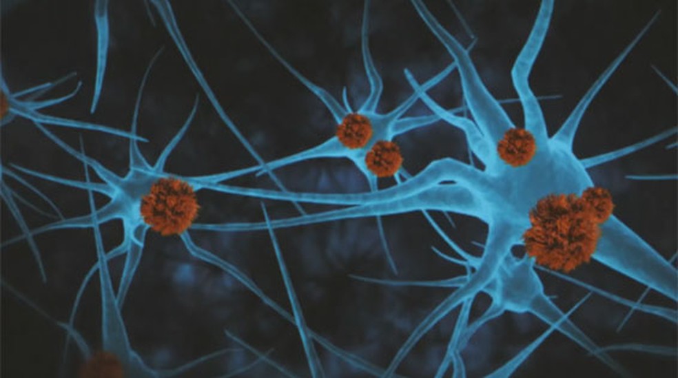 Droga experimental mostrou avanços contra Alzheimer — Foto: Reprodução/TV Globo