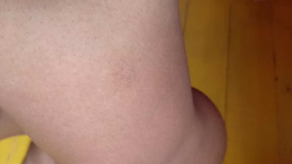 Vítima ficou com marca roxa na perna após ser agredida por segurança de hospital — Foto: Arquivo pessoal