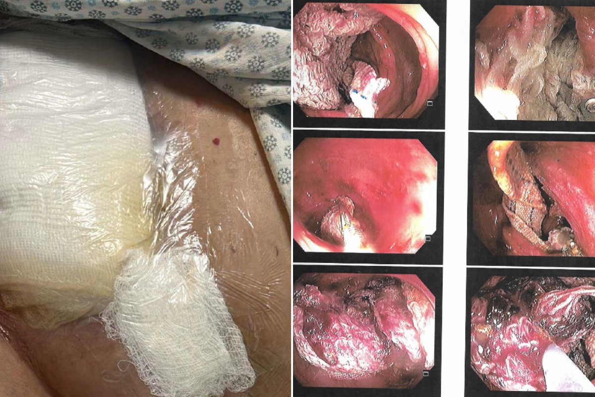 'Revolta pelo erro médico': filha denuncia sequelas em idosa que ficou em coma após gaze esquecida em cirurgia