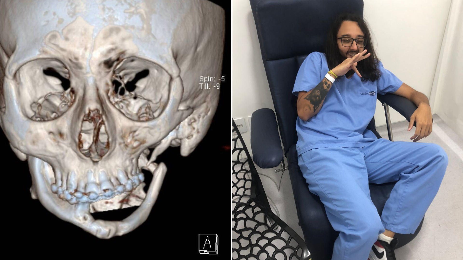 Influencer com maxilar deformado pelo câncer fala sobre expectativa para cirurgia com prótese feita em impressora 3D