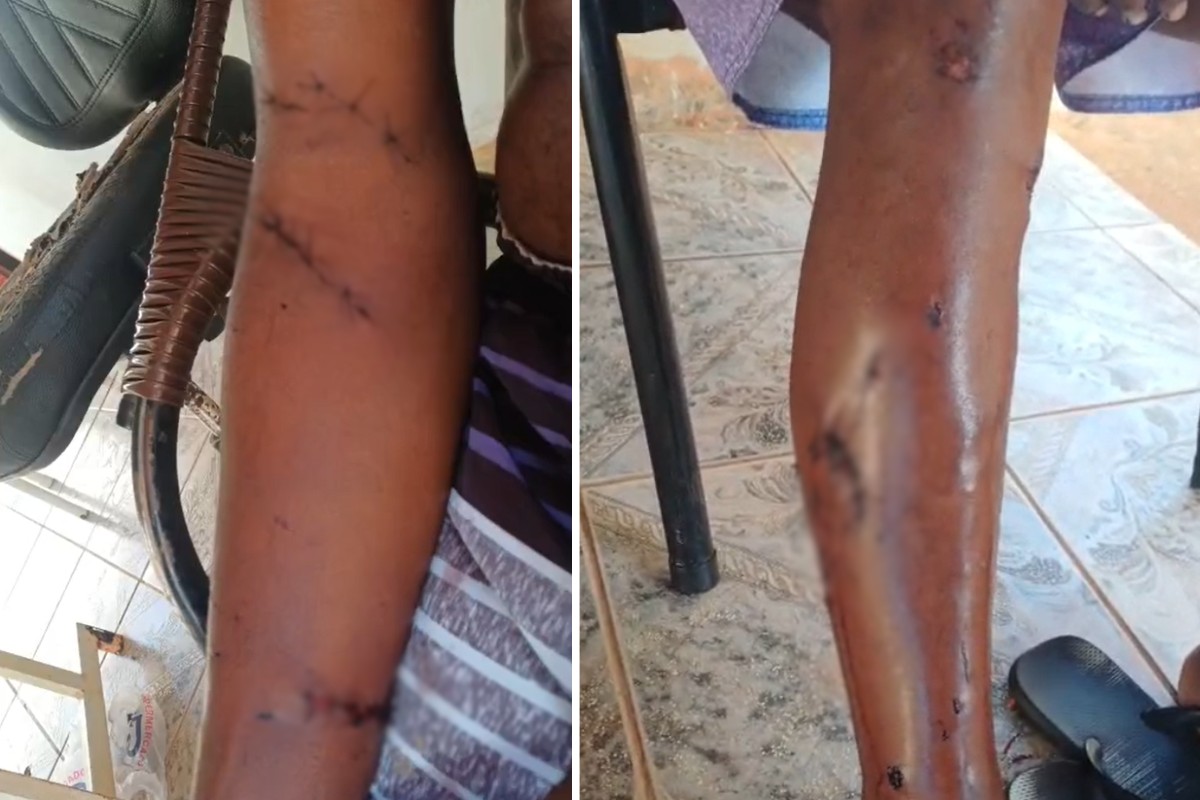 Homem de 61 anos é atacado por pitbull e fica ferido em Tarabai