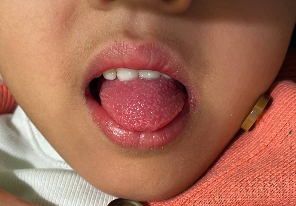 Escarlatina deixa a língua com aspecto de framboesa — Foto: Divulgação/DFTB Skin Deep