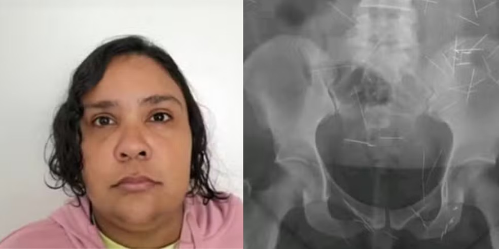 Mulher de 37 anos que fingia ser criança em SC tinha agulhas no corpo | G1