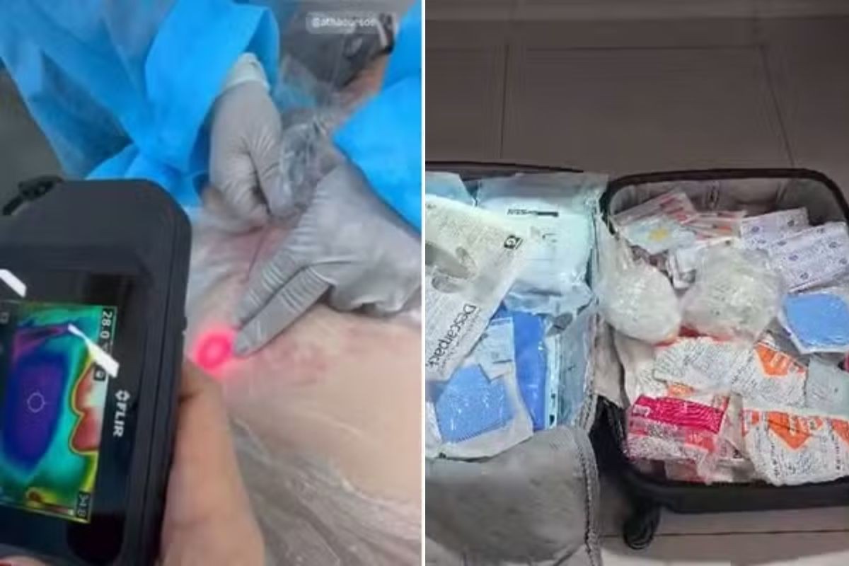 Beautician arrested in clandestine clinic is released after paying bail on the coast of SP