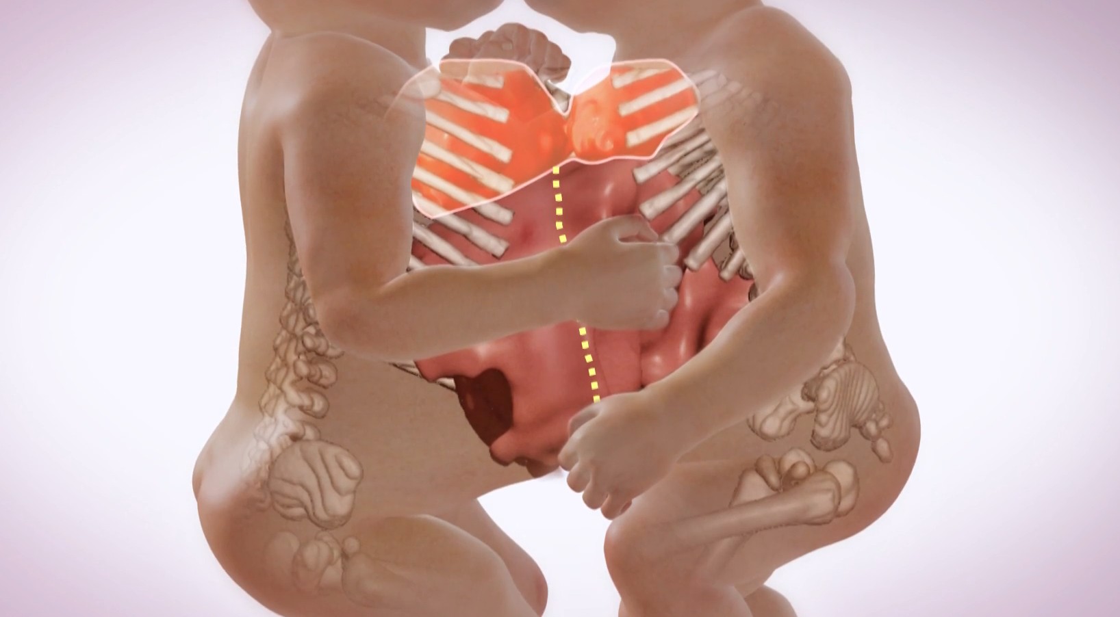 Veja como foi a cirurgia que separou dois bebês siameses que estavam unidos pelo tórax e abdome 