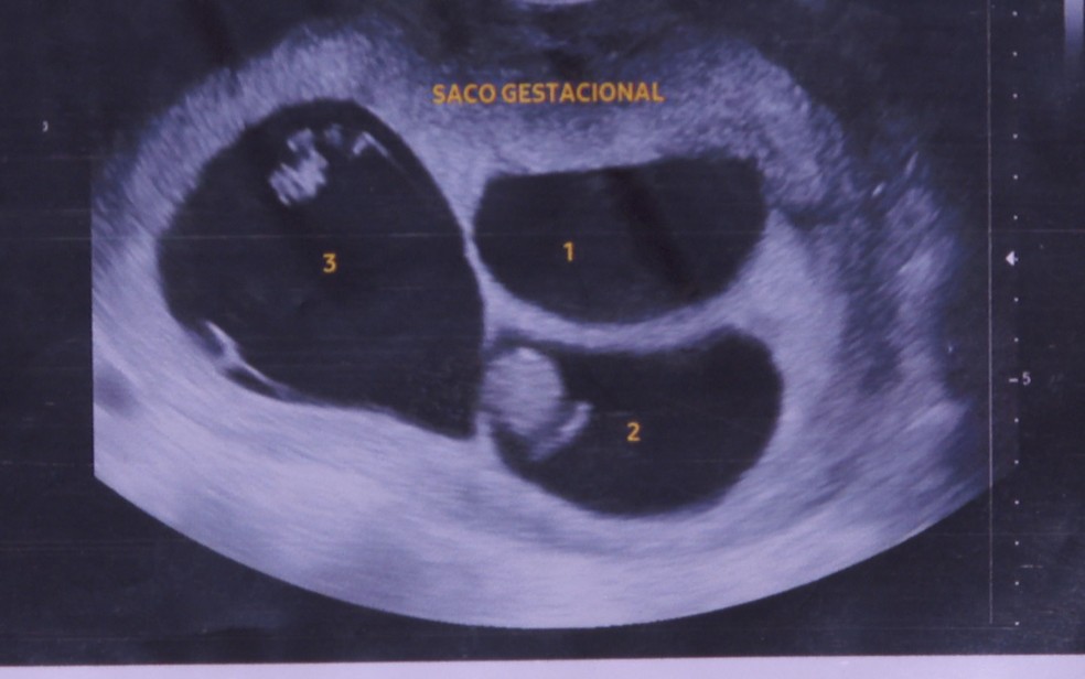 Imagem de ultrassom mostra a gestação de trigêmeos de Denise, moradora de Orlândia, SP. Gravidez natural é considerada raríssima pela medicina — Foto: Arquivo pessoal