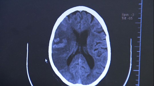 AVC tira a vida de um brasileiro a cada seis minutos