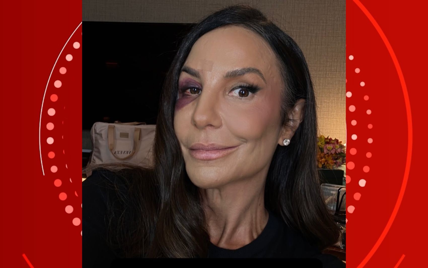 Ivete Sangalo mostra estado do rosto dois dias após queda e recebe apoio de famosos: 'Linda de qualquer jeito'