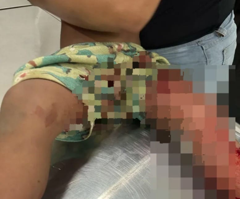 Menino de três anos é atacado por pitbull no interior do Acre