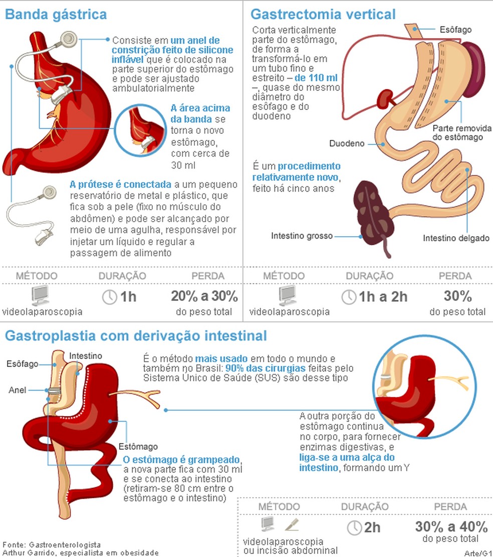 SUS passa a oferecer cirurgia bariátrica por videolaparoscopia | G1