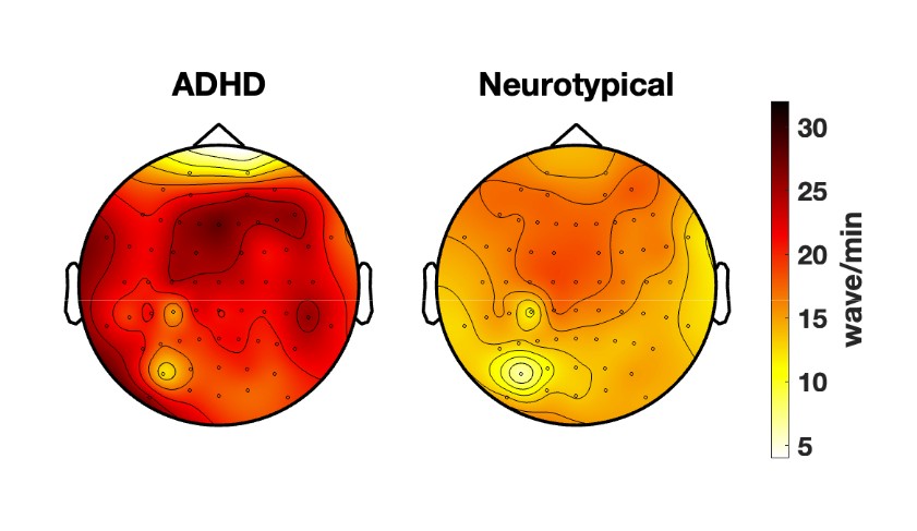 
Cientistas identificam diferenças na atividade cerebral entre adultos com TDAH e sem o transtorno; veja IMAGEM