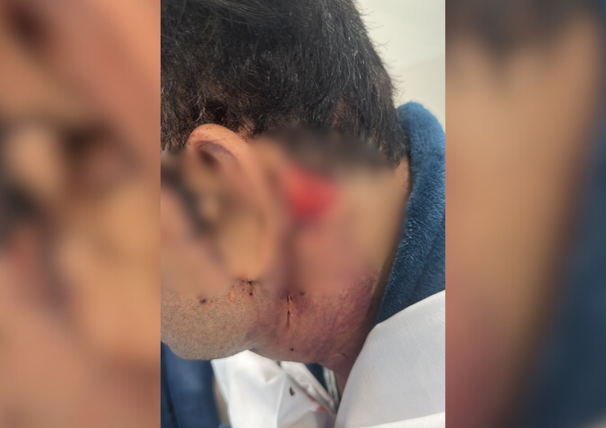 Paciente denuncia suposta negligência de dentista ao ter hemorragia e complicações após fazer 'lipo de papada'