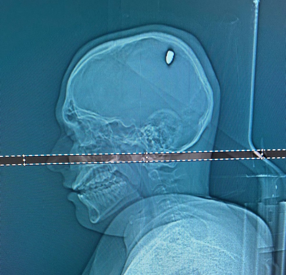 Tomografia realizada em hospital de Juiz de Fora mostra bala alojada na cabeça do estudante mineiro baleado em Cabo Frio — Foto: Arquivo Pessoal