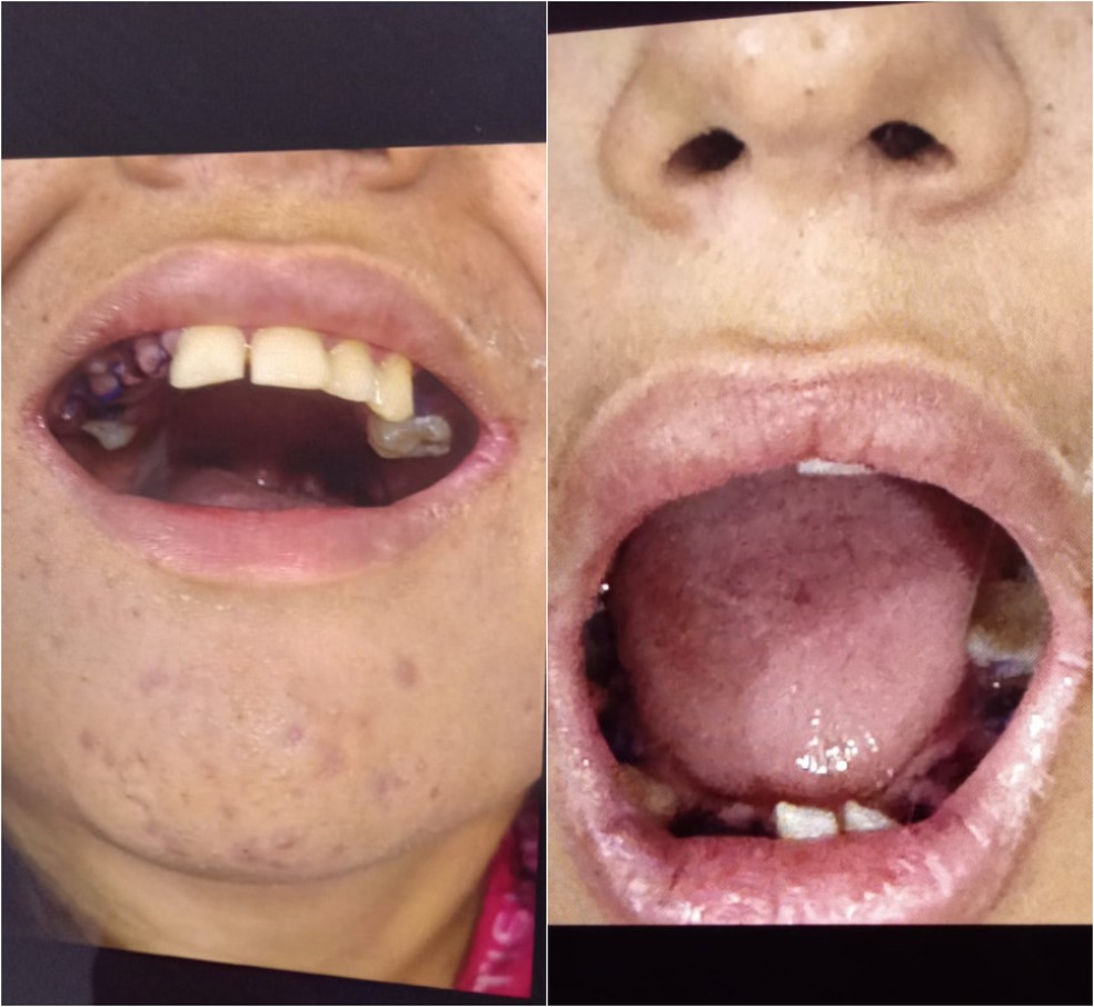 Jovem com autismo ia fazer restaura&ccedil;&atilde;o e acaba com 17 dentes arrancados em unidade de sa&uacute;de no Par&aacute;. &mdash; Foto: Reprodu&ccedil;&atilde;o / Arquivo Pessoal