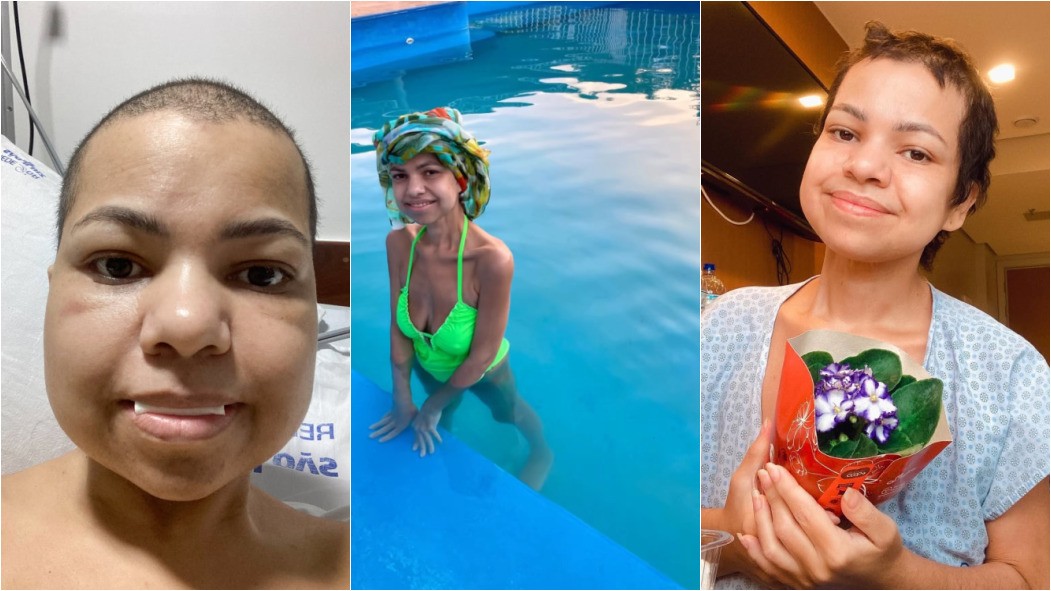 Após bariátrica,  jovem tem quadro raro, passa meses na UTI e reverte cirurgia que causou desnutrição