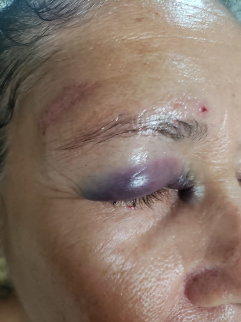 Idosa fica com o olho inchado e roxo após tropeçar em calçada quebrada no  litoral de SP: 'bati a cabeça', Santos e Região