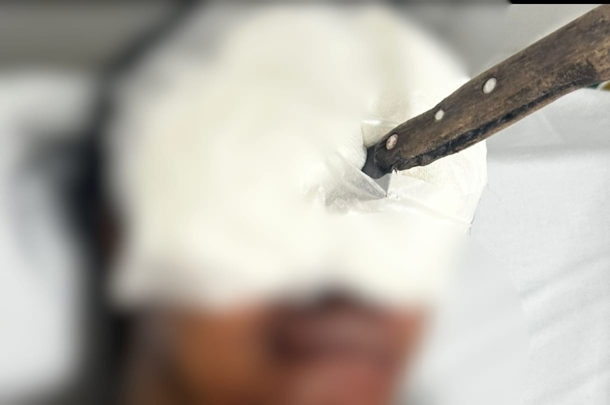 Disputa por terreno termina com faca no olho e traumatismo craniano em Teófilo Otoni