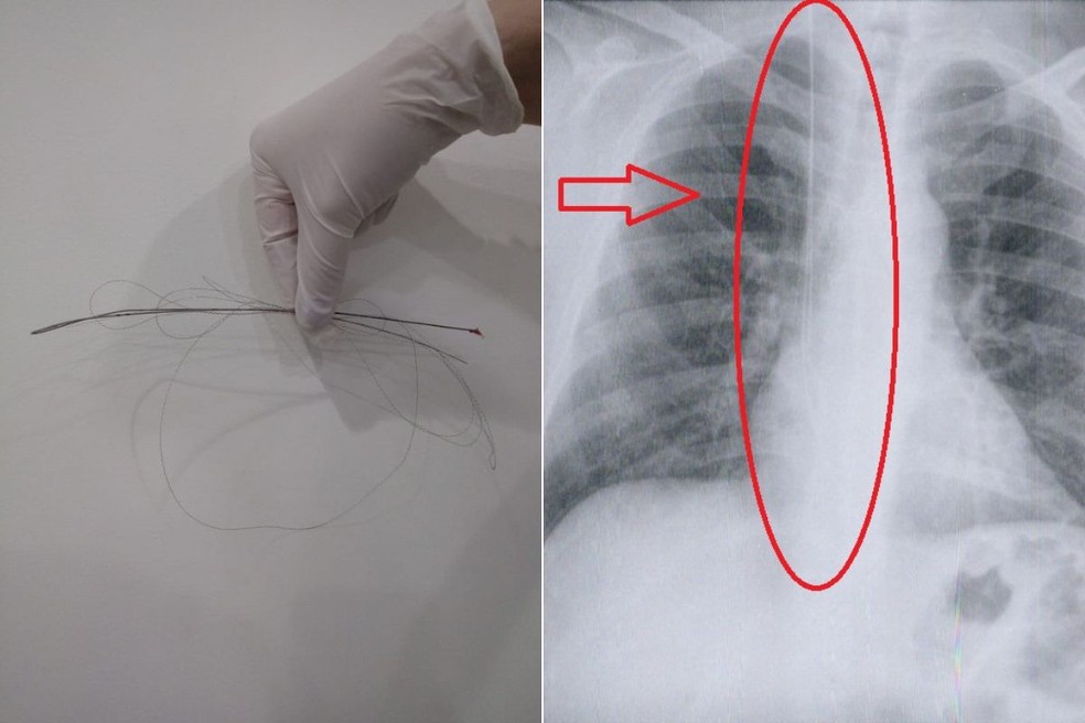 À esquerda, parte do fio-guia esquecido no corpo do paciente. À direita, exame de raios X de Vanes — Foto: Arquivo pessoal e Reprodução