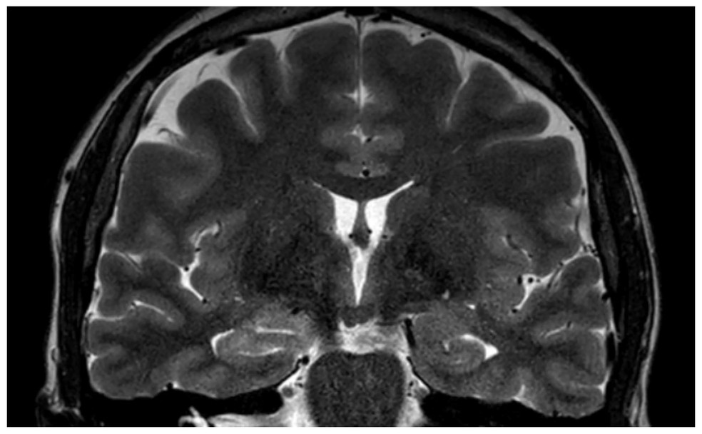Mar&ccedil;o de 2026 (depois do tratamento hormonal). Mostra os dois hipocampos sem a altera&ccedil;&atilde;o clara que havia antes. &mdash; Foto: Universidade de Medicina e Farm&aacute;cia Grigore T. Popa Ia?i, 700115 Ia?i, Rom&ecirc;nia