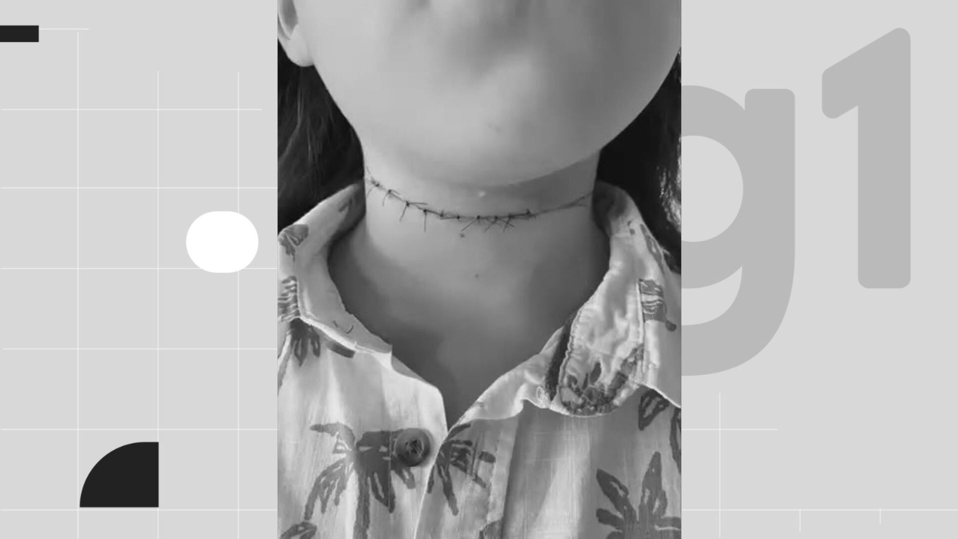 Menino tem pescoço cortado por linha de cerol durante passeio de bicicleta; VÍDEO