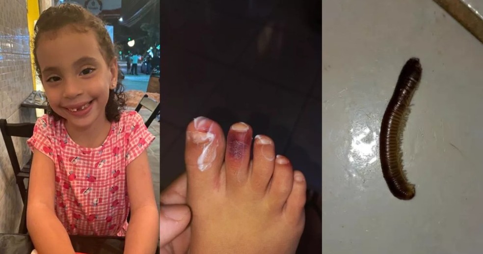 Piolho de cobra se esconde em t nis e menina de 6 anos fica ferida