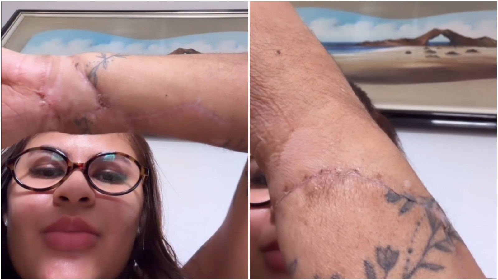 Mulher que teve mãos amputadas pelo ex mostra cicatrizes pela 1ª vez após reimplante: 'marcas do meu milagre'