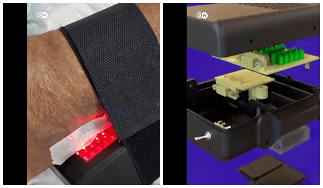 Tecnologia brasileira visa reduzir número de amputações por diabetes 