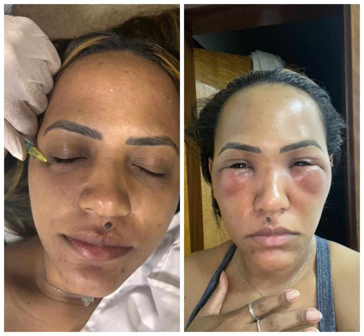 Mulher tem olhos inchados após procedimento estético