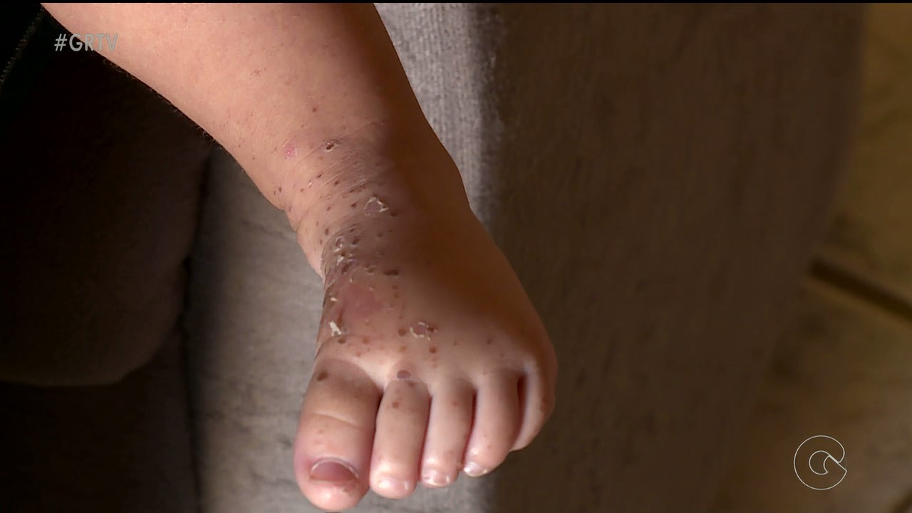 G1 - 'Inexplicável', diz mãe de jovem ferida após explosão de secador no RS  - notícias em Rio Grande do Sul