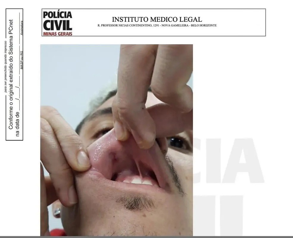 Foto mostra ferimento na boca de Pedro após soco; confusão aconteceu após jogo do Flamengo no Independência | Minas Gerais | G1