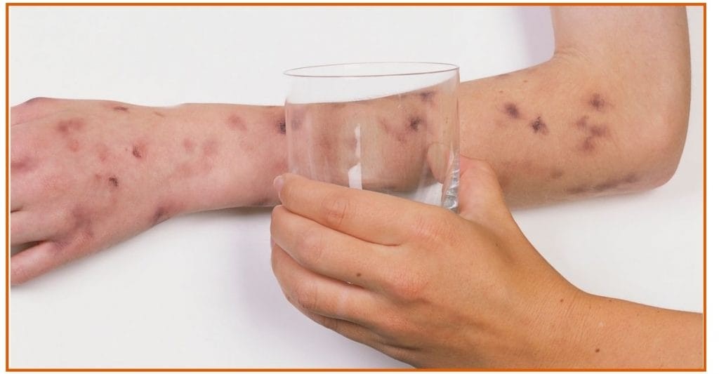 União dos Palmares registra caso de meningite B; saiba o que é, sintomas e como tratar