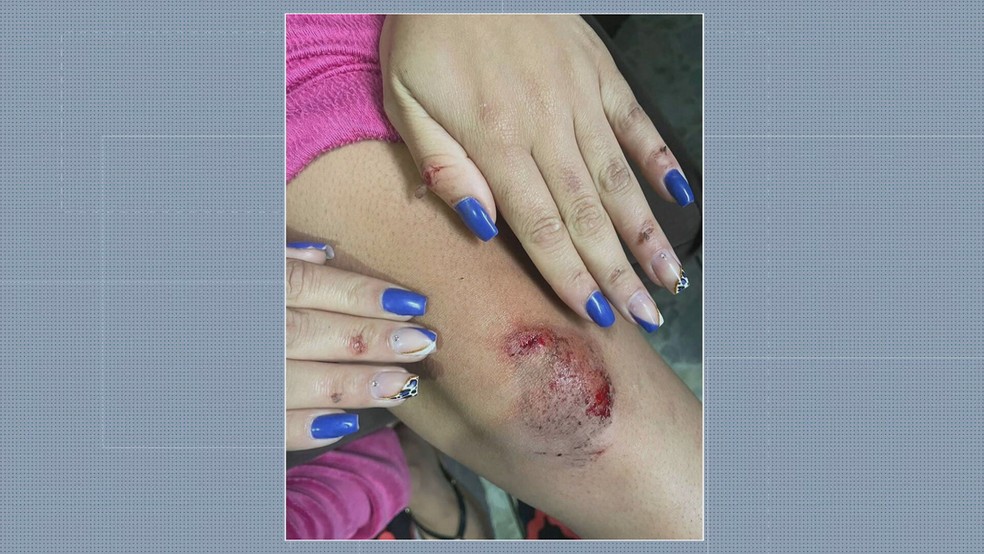 Jovem mostra ferimentos após pular de carro em movimento dirigido por motorista da 99. — Foto: Reprodução/TV Globo