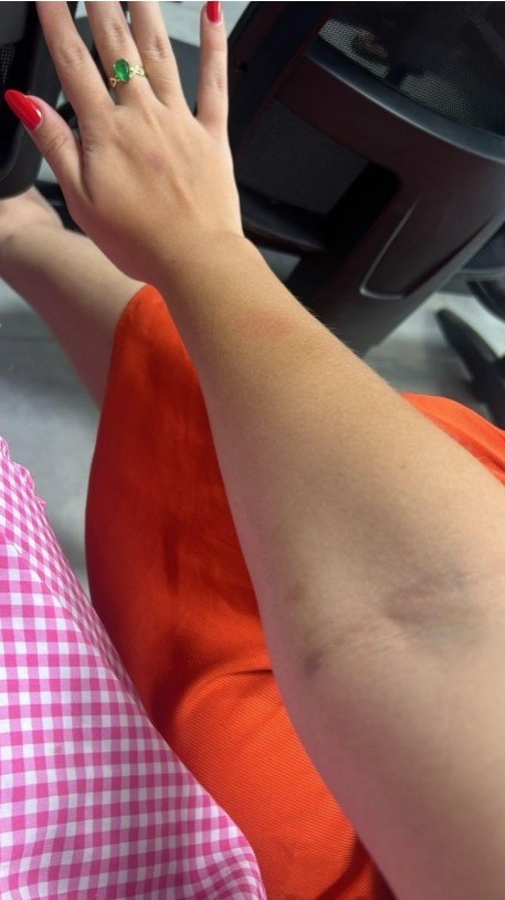 Hematoma no braço de uma das irmãs — Foto: Reprodução