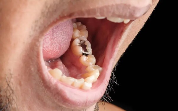 O fim da restauração prateada e os novos caminhos da odontologia