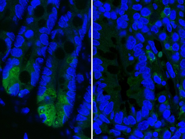 Doenças inflamatórias intestinais crescem mais de cinco vezes no Brasil em 13 anos