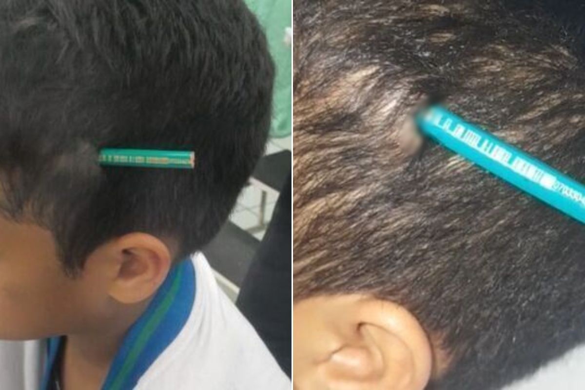 Neurologista alerta para riscos após menino de 9 anos ficar com lápis cravado na cabeça no litoral de SP
