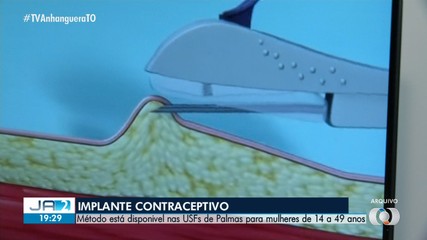 Implante contraceptivo está disponível nas USFs de Palmas