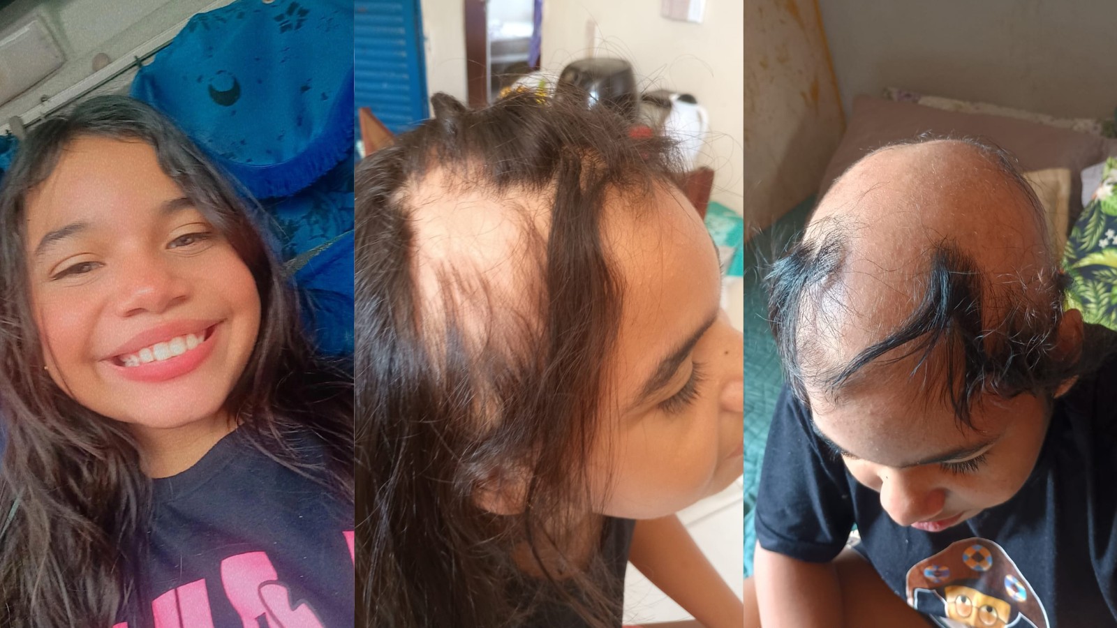 Menina de 11 anos perde os cabelos após diagnóstico de alopecia no PI: 'sempre usou comprido', relata mãe sobre luta