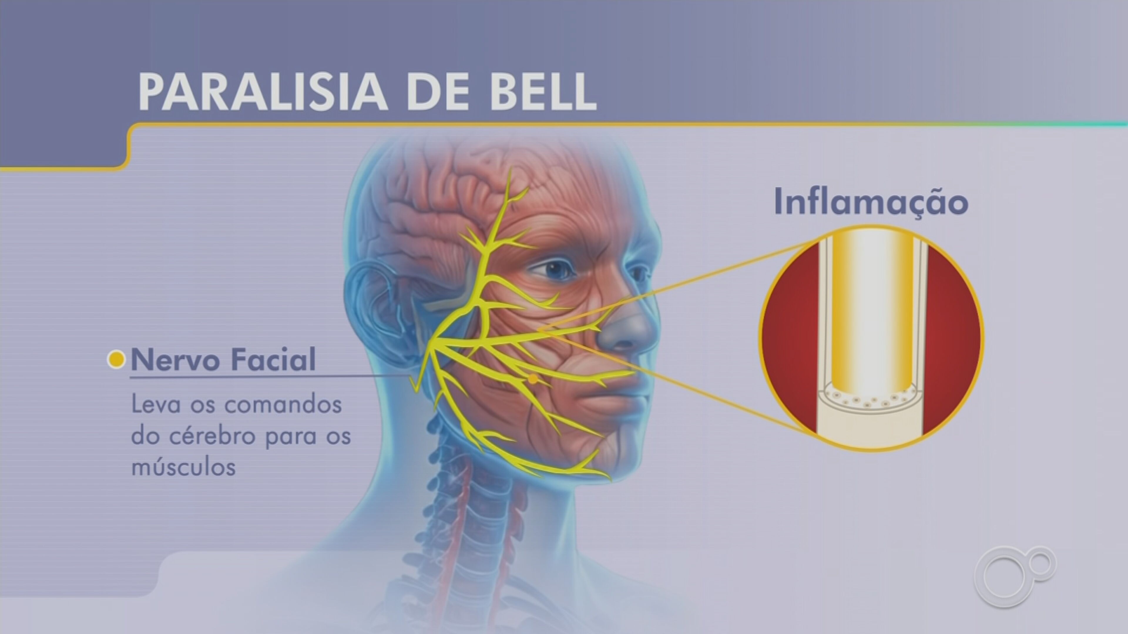 Paralisia de Bell: jornalista relata susto e desafios da recuperação de doença que 'congela' parte do rosto