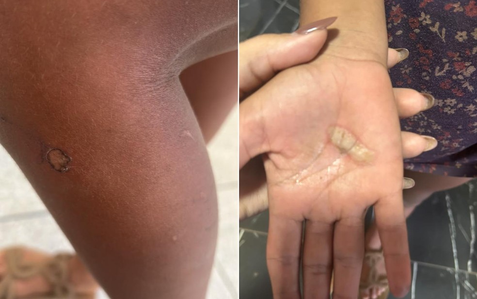 Imagens mostram lesões nas mãos e na perna das crianças; pai é suspeito de usar objeto aquecido para castigá-las — Foto: Divulgação/Polícia Civil